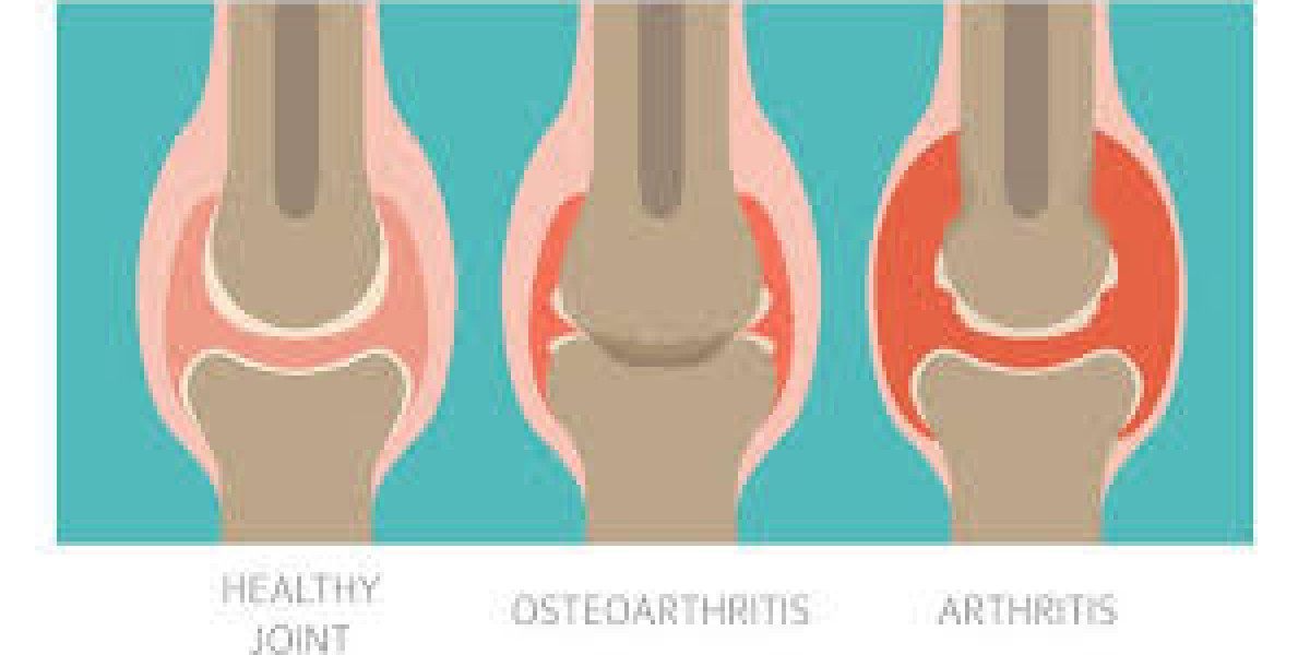 Osteoarthritis or Rheumatoid Arthritis? Which One Is Causing Your Pain