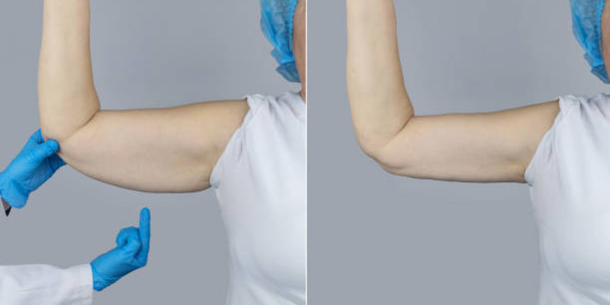 Non-Surgical Fat Reduction for Stubborn Areas