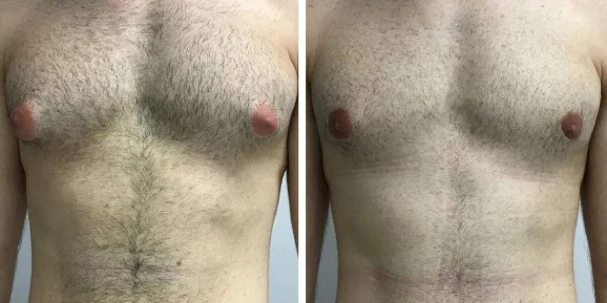 Booking Tips for Best Gynecomastia Surgeons in dubai