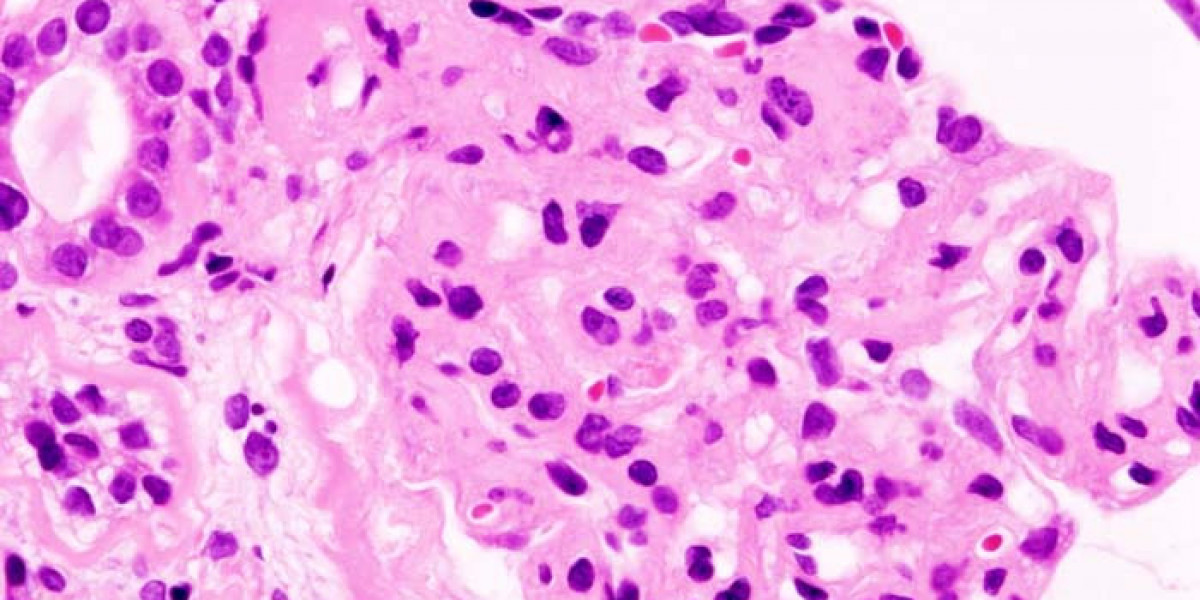 Kidney Health Matters: Insights into Protein-Losing Kidney Conditions